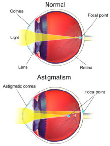 Astigmatism Eye Graphic Explanation