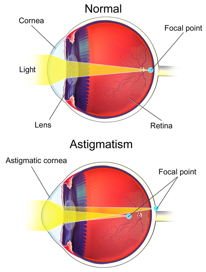 Astigmatism Central Florida Eye Center, P.A.