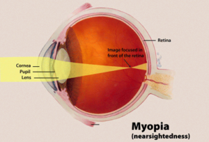 Myopia Eye Disease