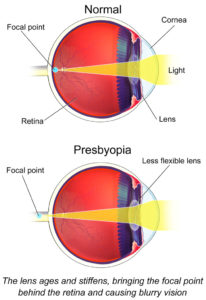 Presbyopia Eye Disease