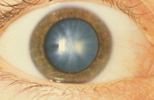 Eye human eye with Cataract