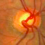 Glaucoma Eye Disorder