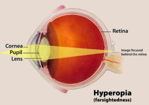 Hyperopia Eye Disease