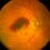 Macular Degeneration Eye Disorder
