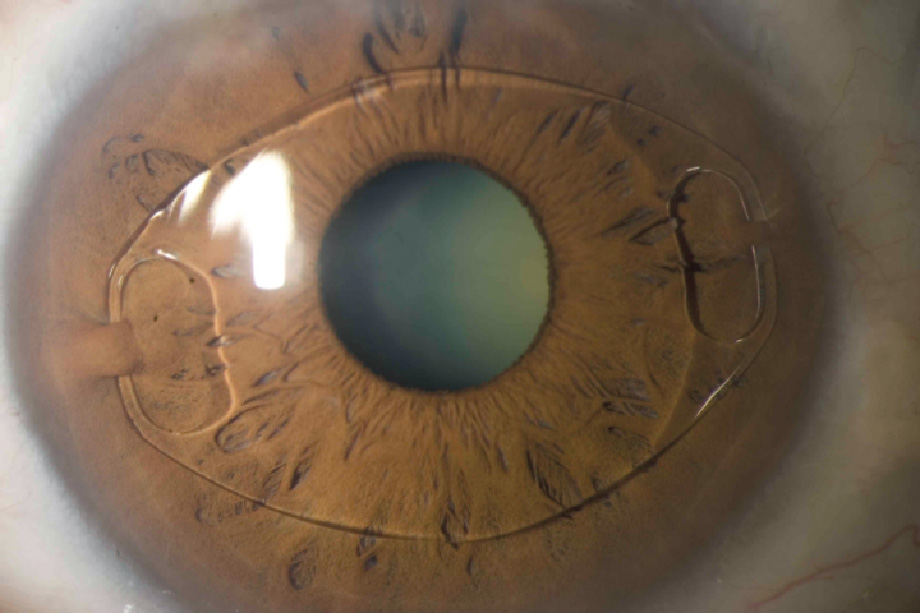 Afscheiden Luchtvaart onvoorwaardelijk Implantable Contact Lenses – Central Florida Eye Center, P.A.
