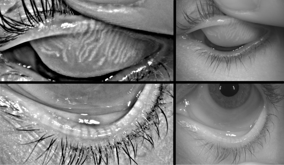 Doctor is checking the oil glands in the eyelid for damage or loss.