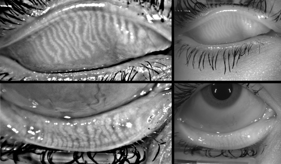 Evaporative Dry Eye/Meibomian Gland Dysfunction