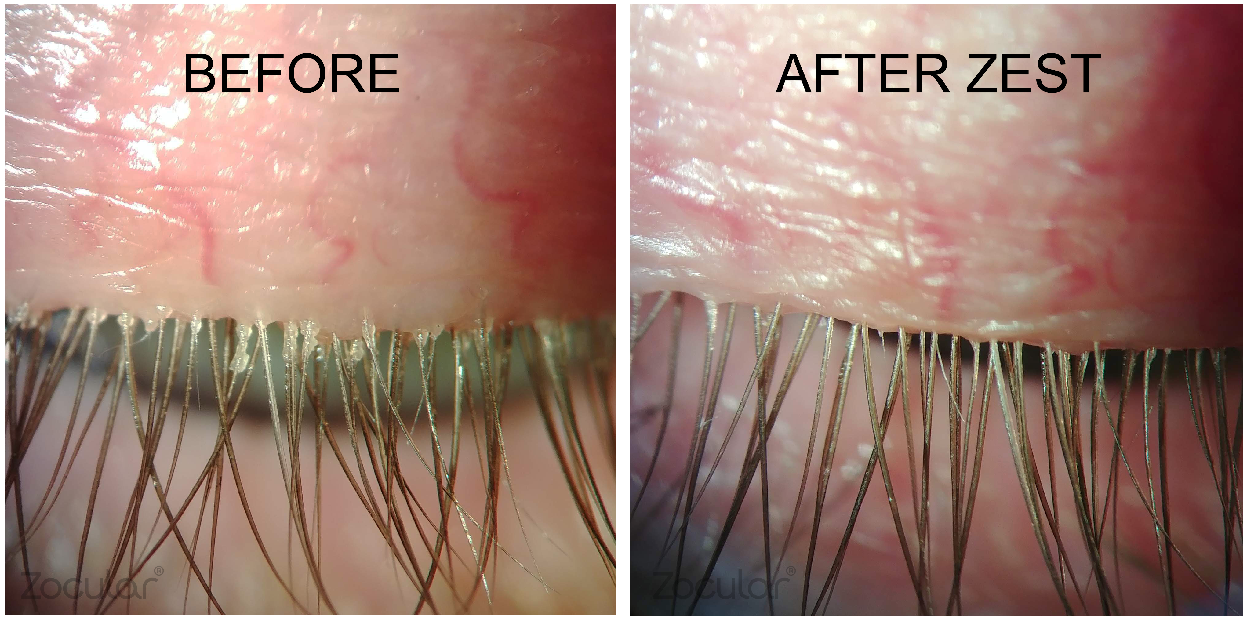 Zocular Eyelid System Treatment (ZEST)